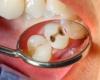 طبيب أسنان يبدد الأسطورة الشائعة حول فوائد الصودا الحلوة